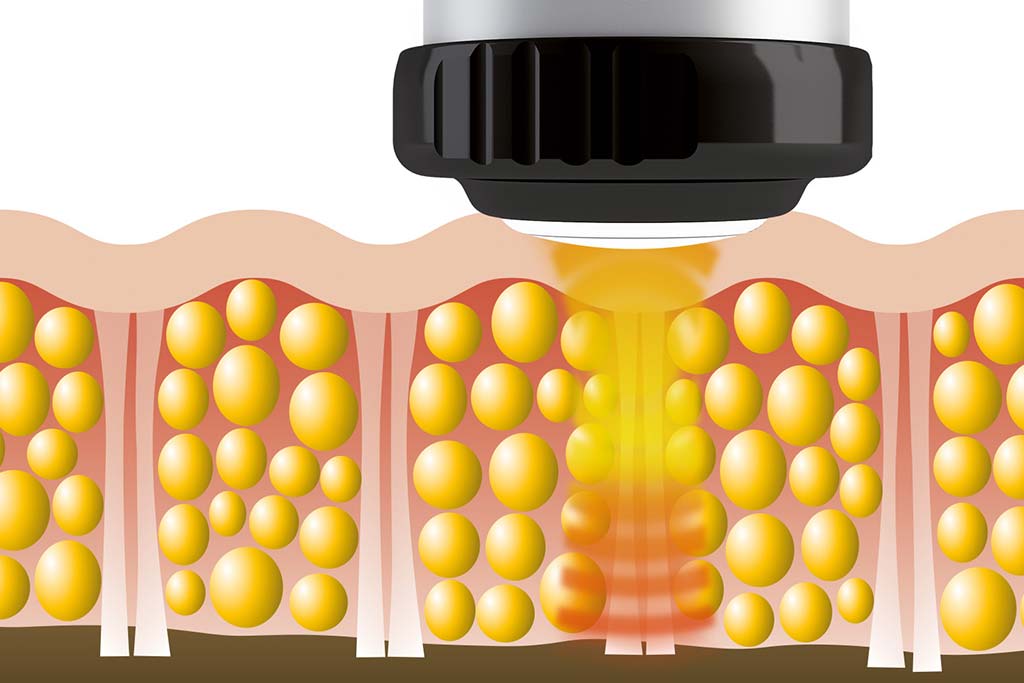 COSA SONO LE ONDE D'URTO? | Poliambulatorio Villa Ferri Medica COSA SONO LE ONDE D'URTO? | Poliambulatorio Villa Ferri Medica